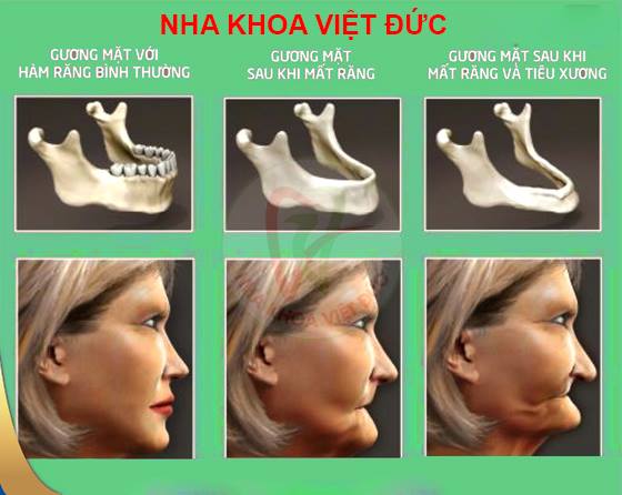 NHỮNG HẬU QUẢ KHÔN LƯỜNG CỦA VIỆC MẤT RĂNG