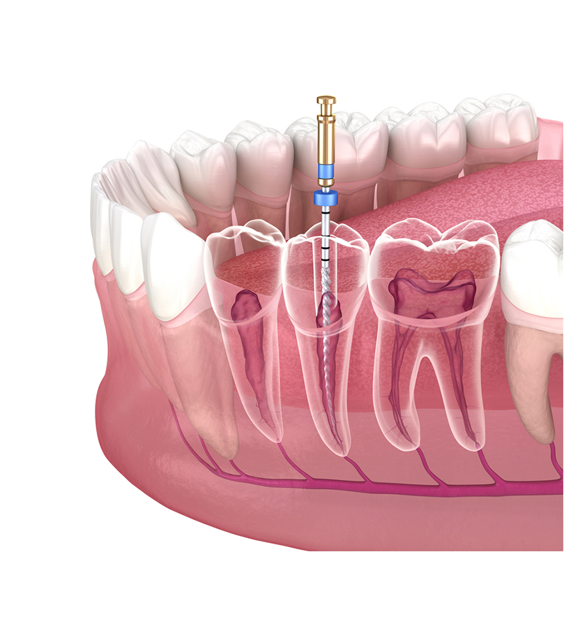 Điều Trị Nội Nha, Viêm Tủy Răng
