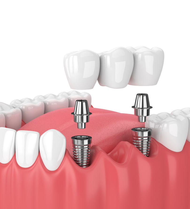 CẤY GHÉP IMPLANT