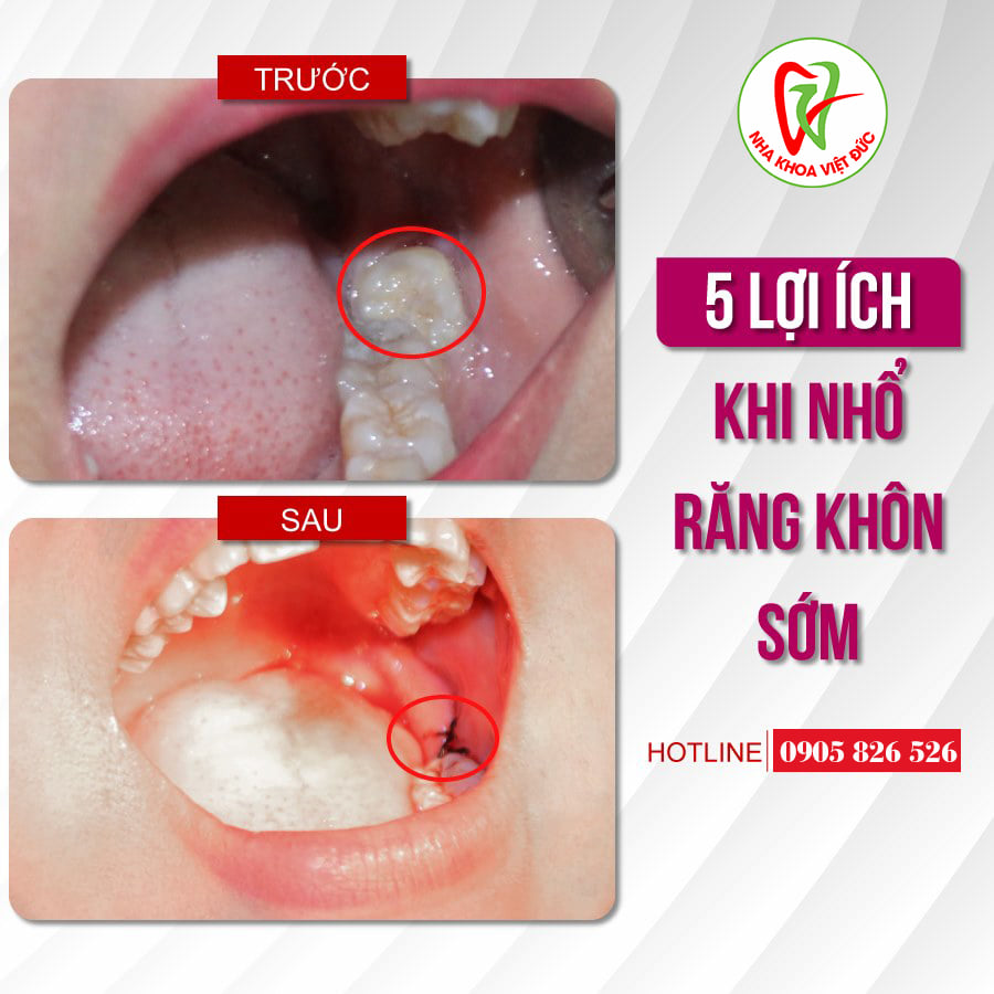 5 LỢI ÍCH KHI NHỔ RĂNG KHÔN SỚM