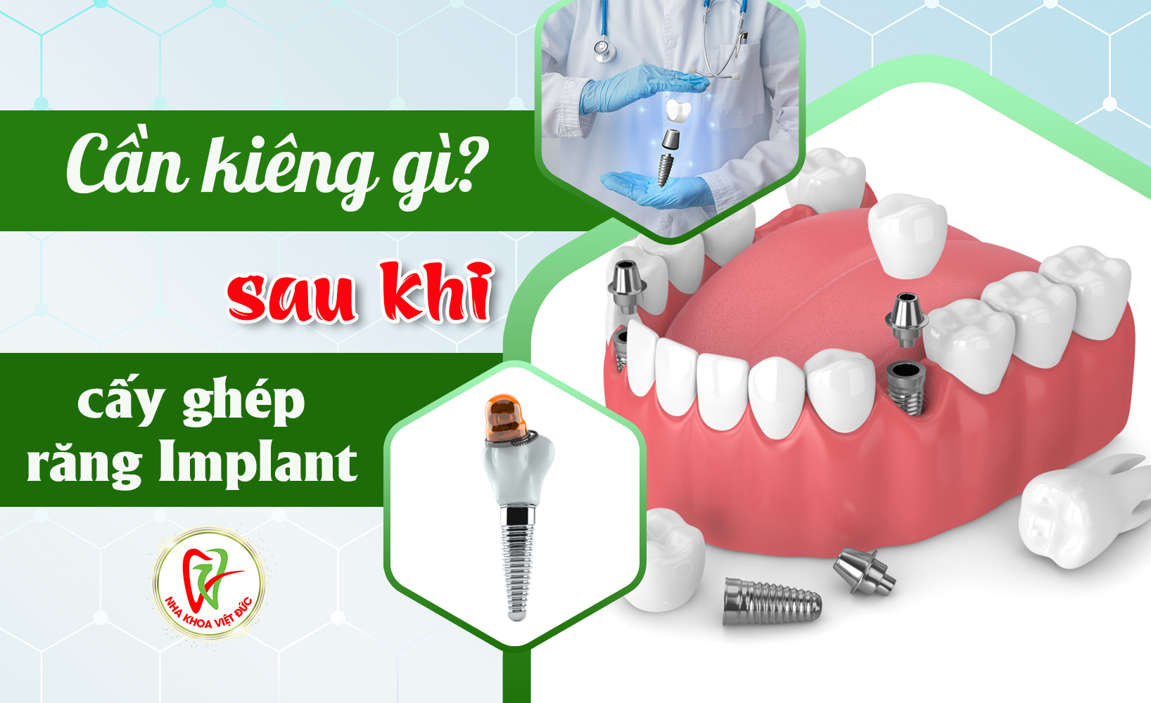 CẦN KIÊNG GÌ SAU KHI CẤY GHÉP RĂNG IMPLANT