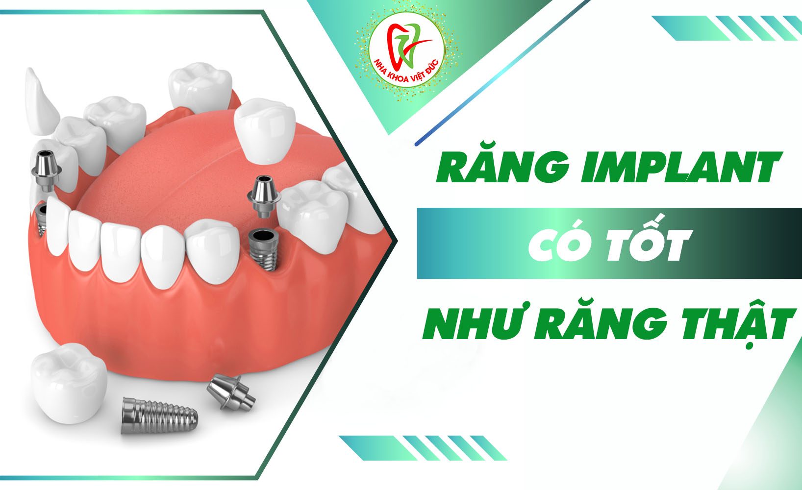 RĂNG IMPLANT CÓ TỐT NHƯ RĂNG THẬT?