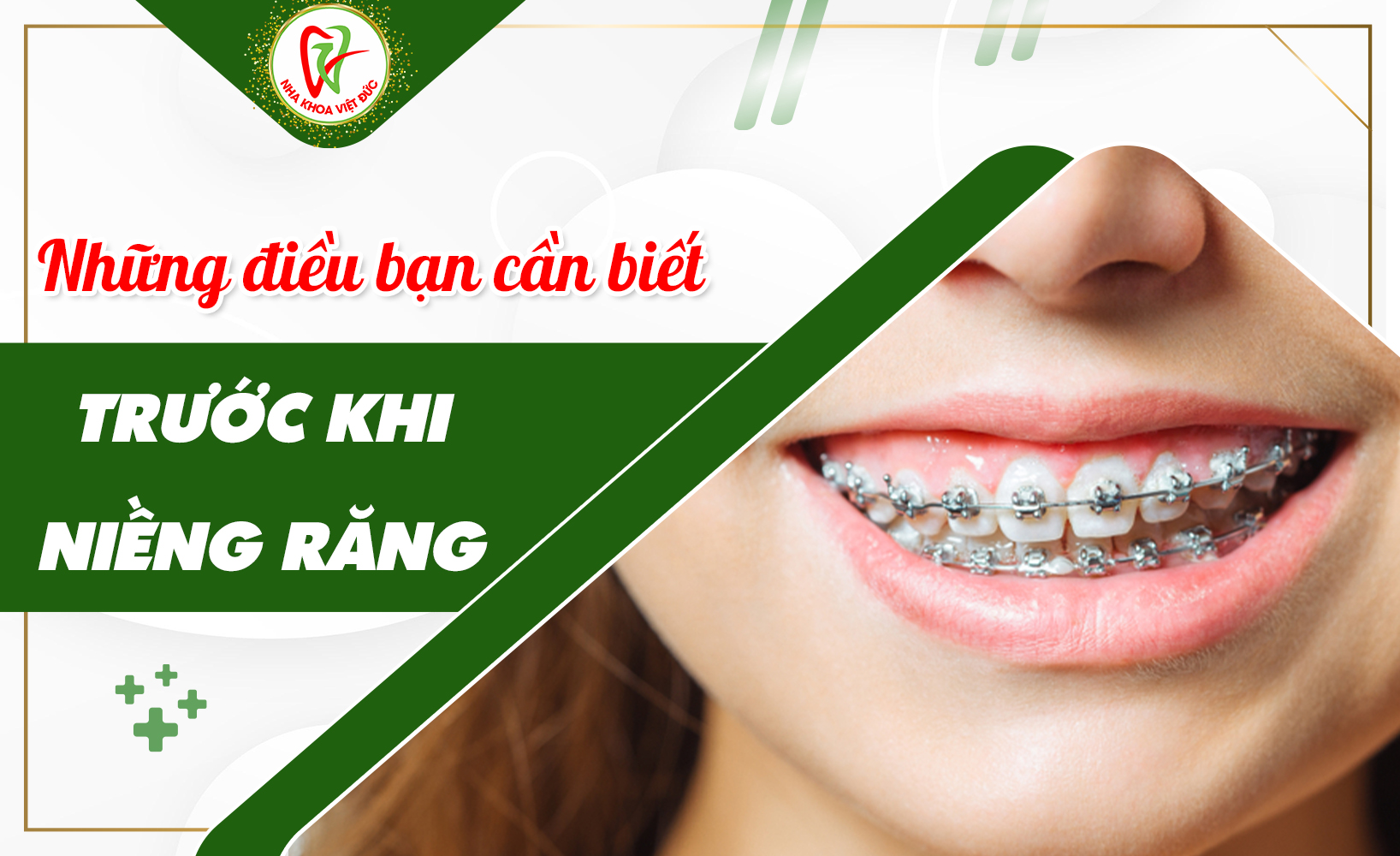 NHỮNG ĐIỀU BẠN CẦN BIẾT TRƯỚC KHI NIỀNG RĂNG