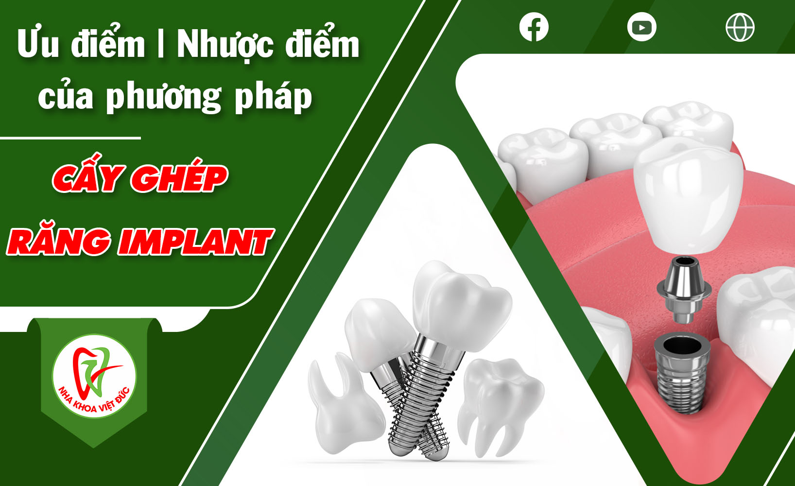 ƯU, NHƯỢC ĐIỂM CỦA PHƯƠNG PHÁP CẤY GHÉP RĂNG IMPLANT