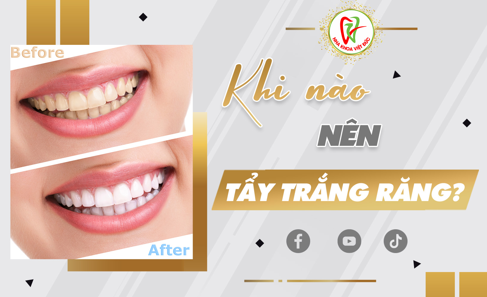 KHI NÀO NÊN TẨY TRẮNG RĂNG?