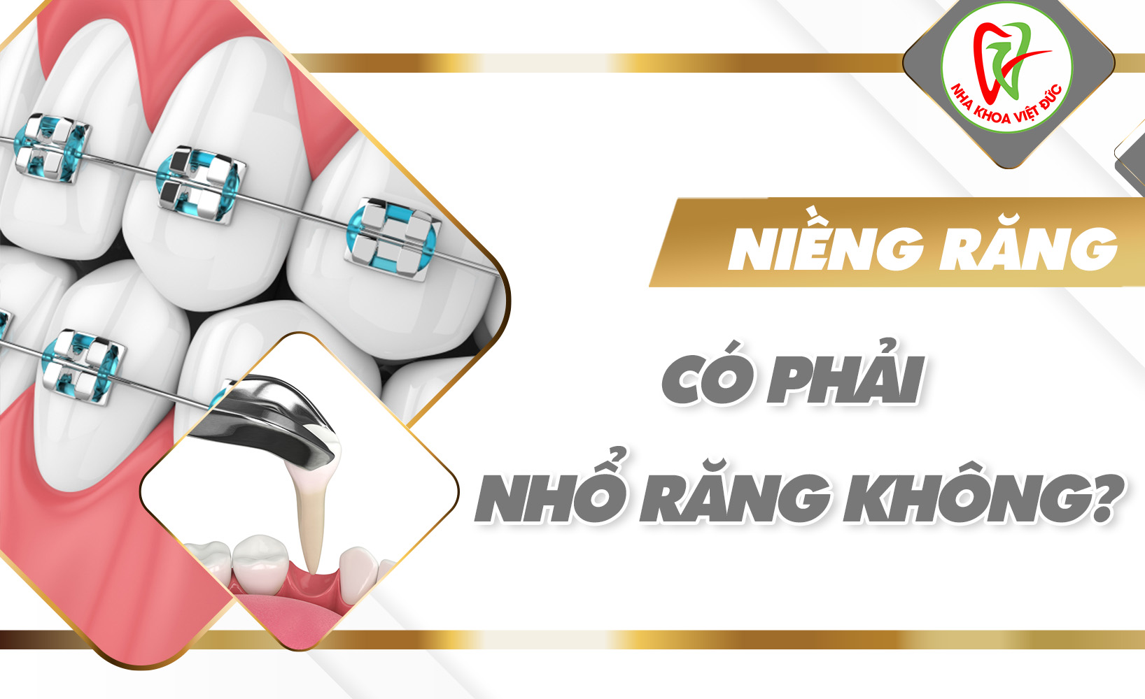 NIỀNG RĂNG CÓ PHẢI NHỔ RĂNG KHÔNG?