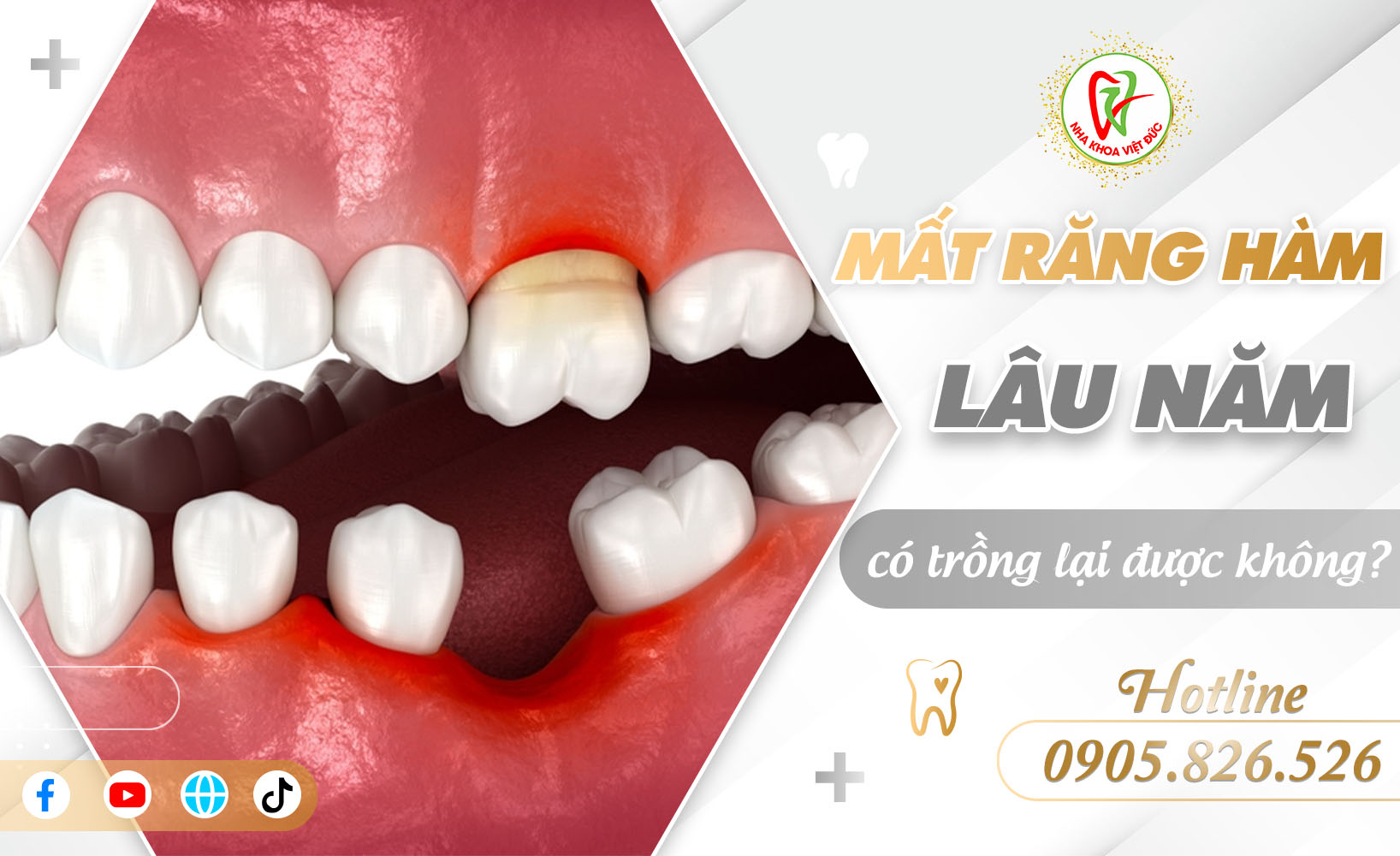 MẤT RĂNG HÀM LÂU NĂM CÓ TRỒNG LẠI ĐƯỢC KHÔNG?