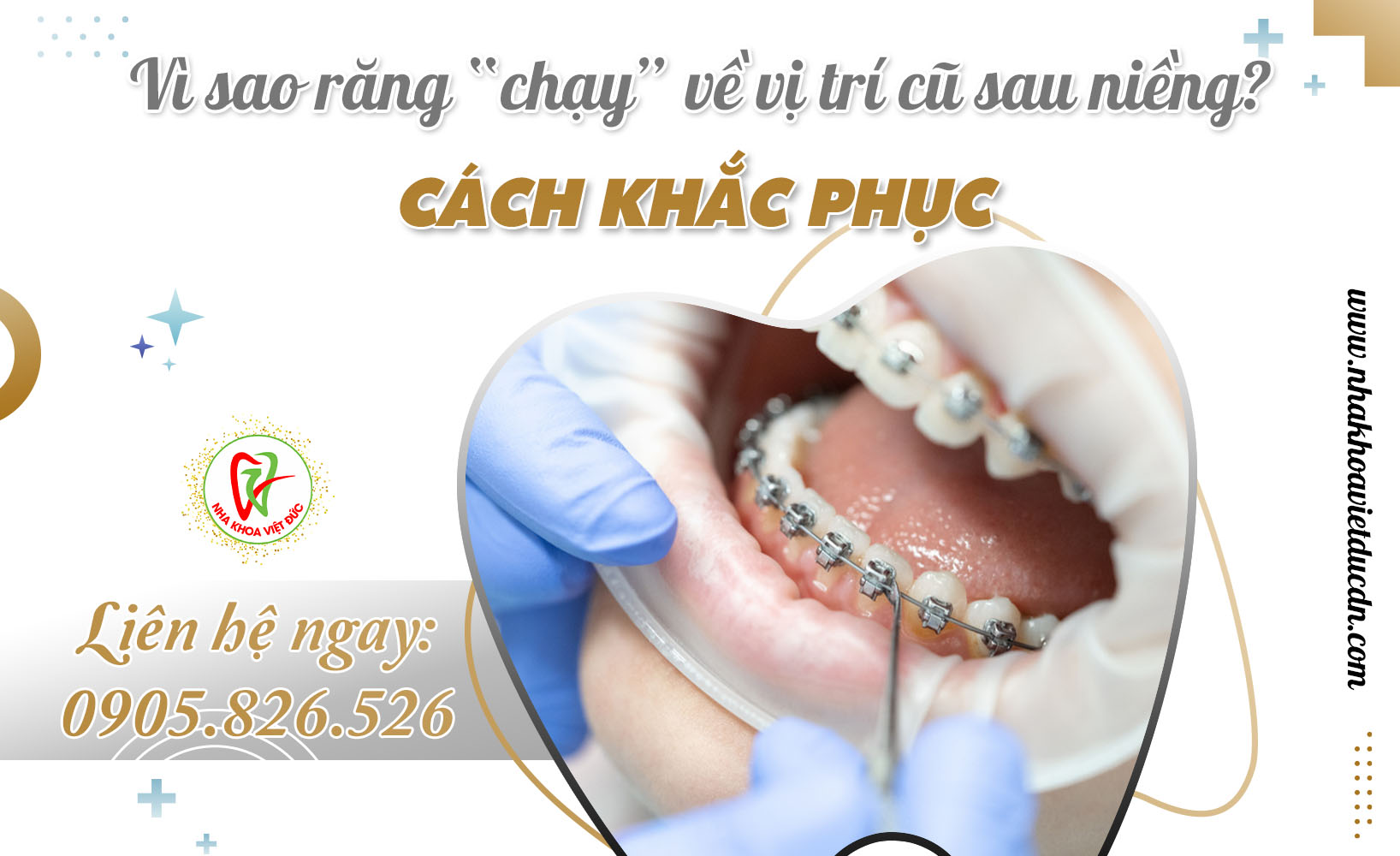 VÌ SAO RĂNG CHẠY VỀ VỊ TRÍ CŨ SAU NIỀNG? CÁCH KHẮC PHỤC