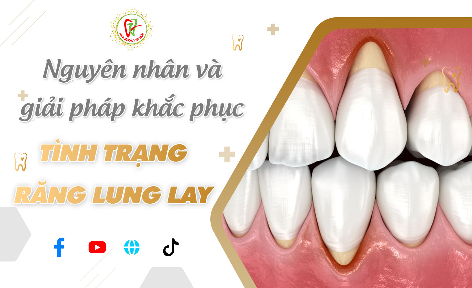 NGUYÊN NHÂN VÀ GIẢI PHÁP KHẮC PHỤC TÌNH TRẠNG RĂNG LUNG LAY