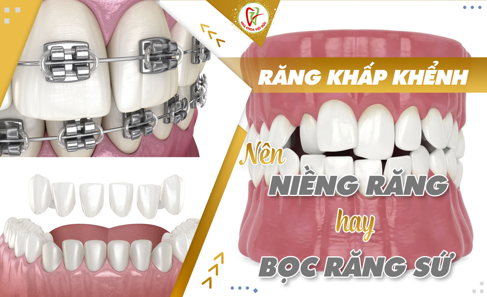 NÊN NIỀNG RĂNG HAY BỌC RĂNG SỨ KHI RĂNG BỊ KHẤP KHỂNH