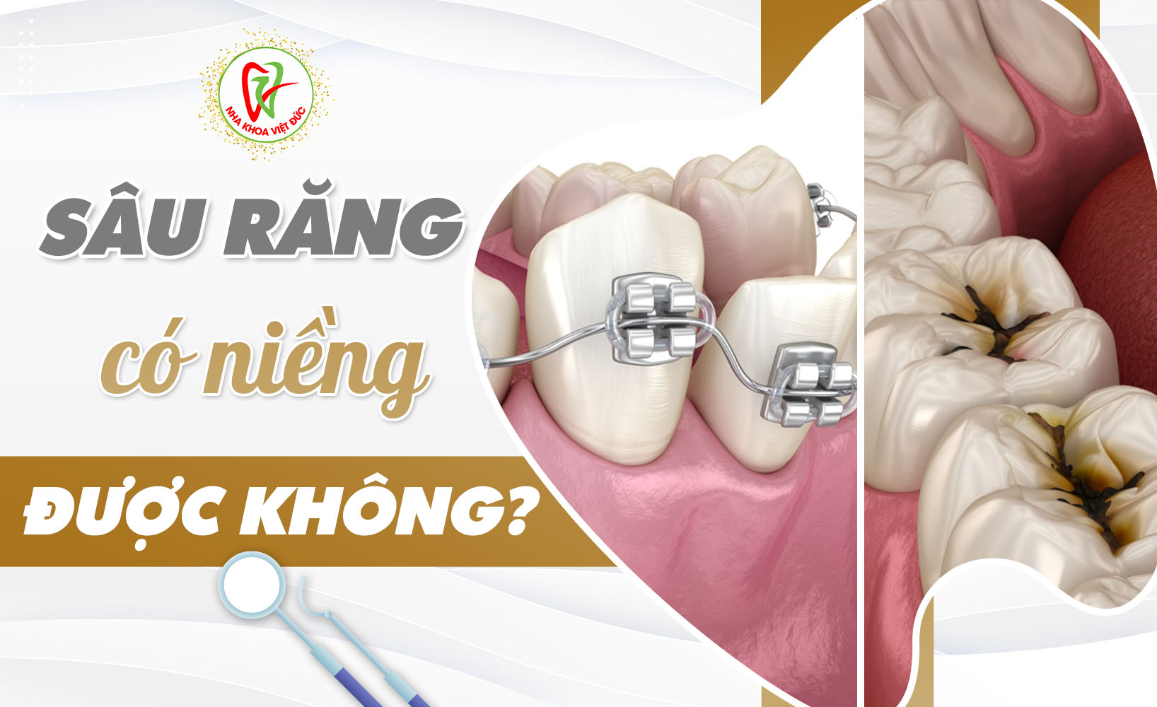 SÂU RĂNG CÓ NIỀNG ĐƯỢC KHÔNG?