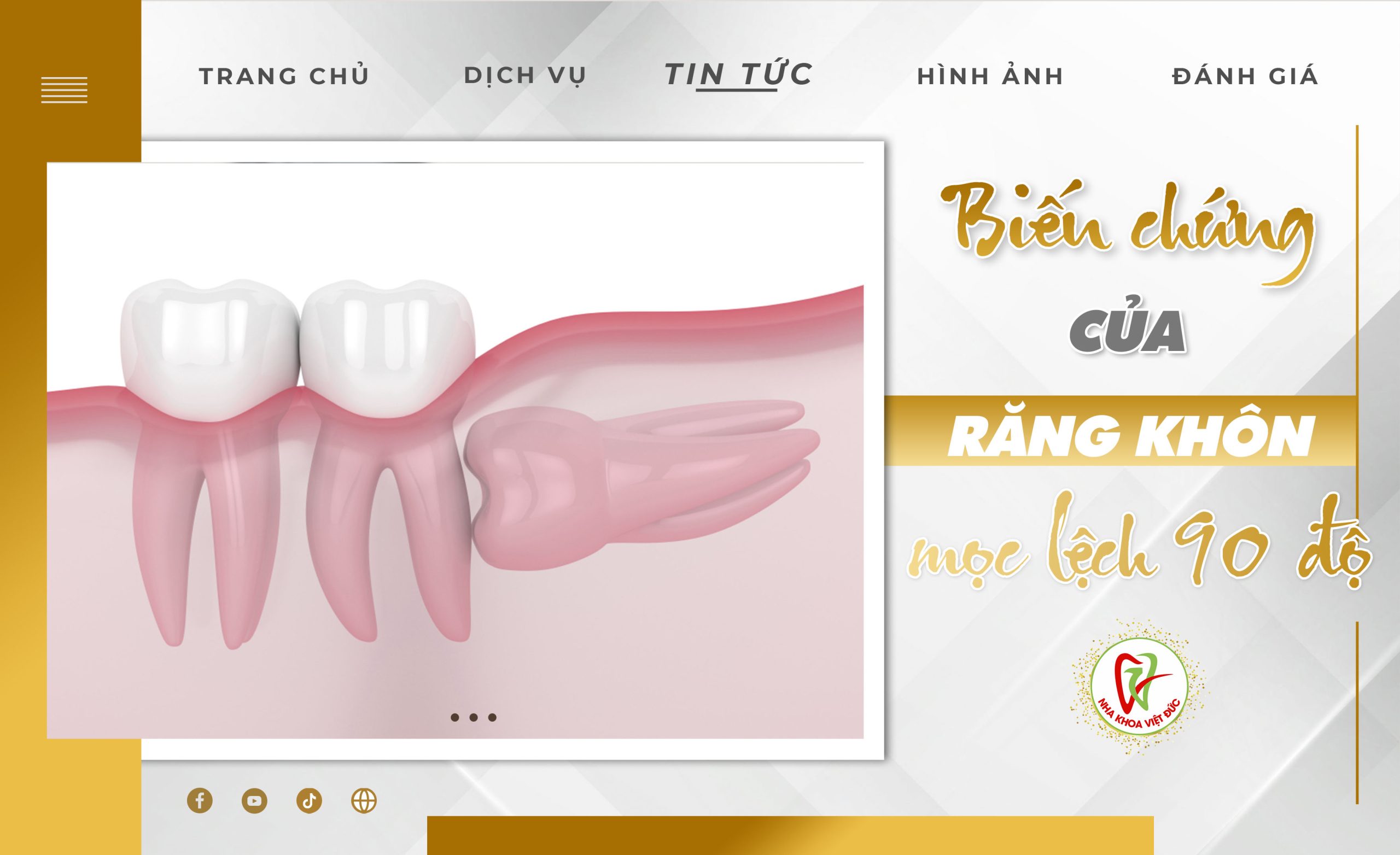 BIẾN CHỨNG CỦA RĂNG KHÔN MỌC LỆCH 90 ĐỘ