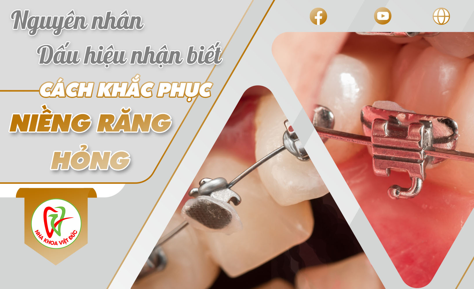 NGUYÊN NHÂN, DẤU HIỆU NHẬN BIẾT VÀ CÁCH KHẮC PHỤC NIỀNG RĂNG HỎNG