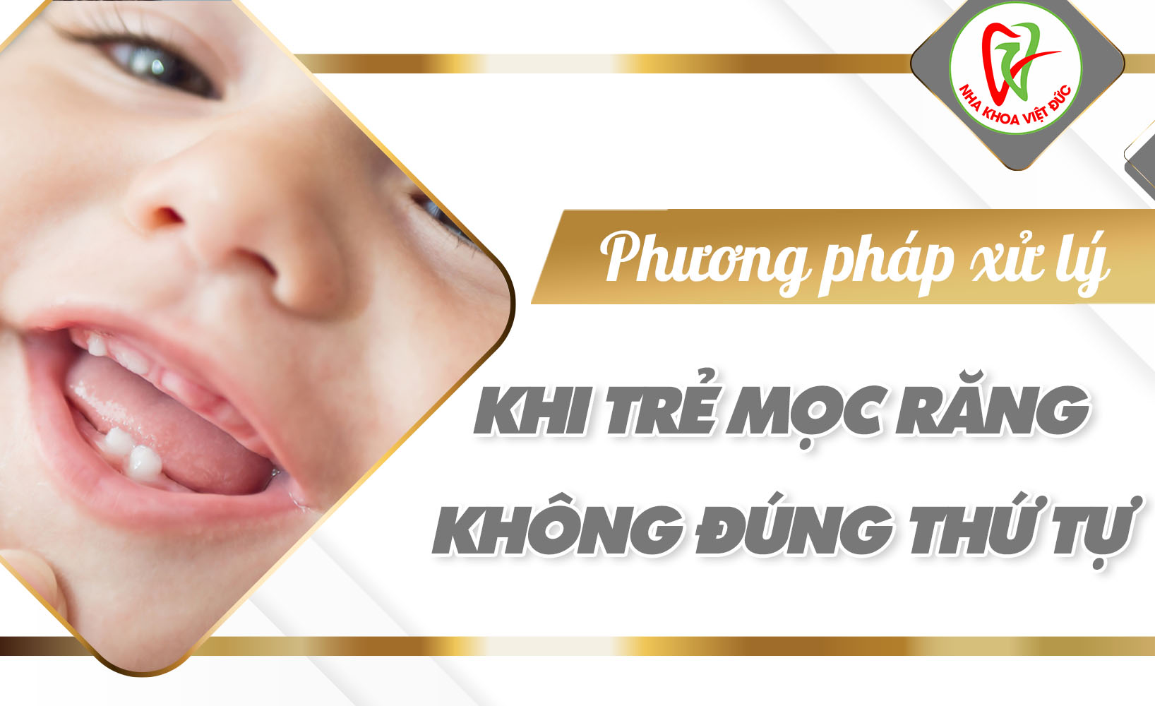 PHƯƠNG PHÁP XỬ LÝ KHI TRẺ MỌC RĂNG KHÔNG ĐÚNG THỨ TỰ