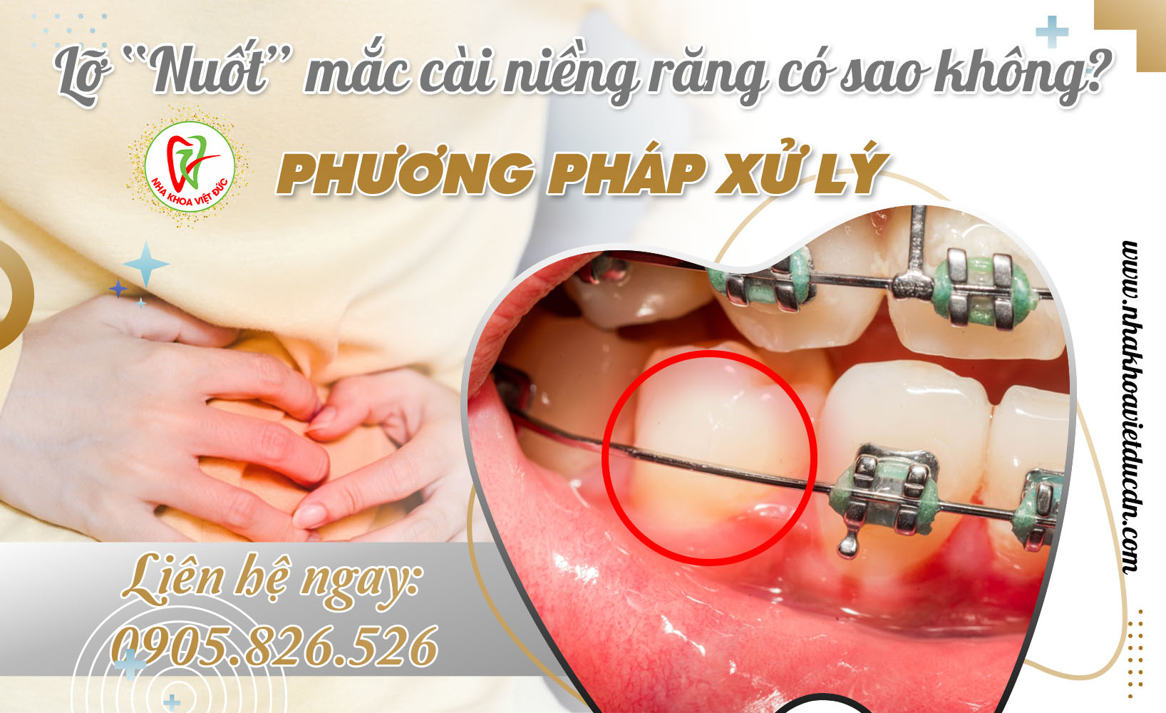 LỠ NUỐT MẮC CÀI NIỀNG RĂNG CÓ SAO KHÔNG? PHƯƠNG PHÁP XỬ LÝ