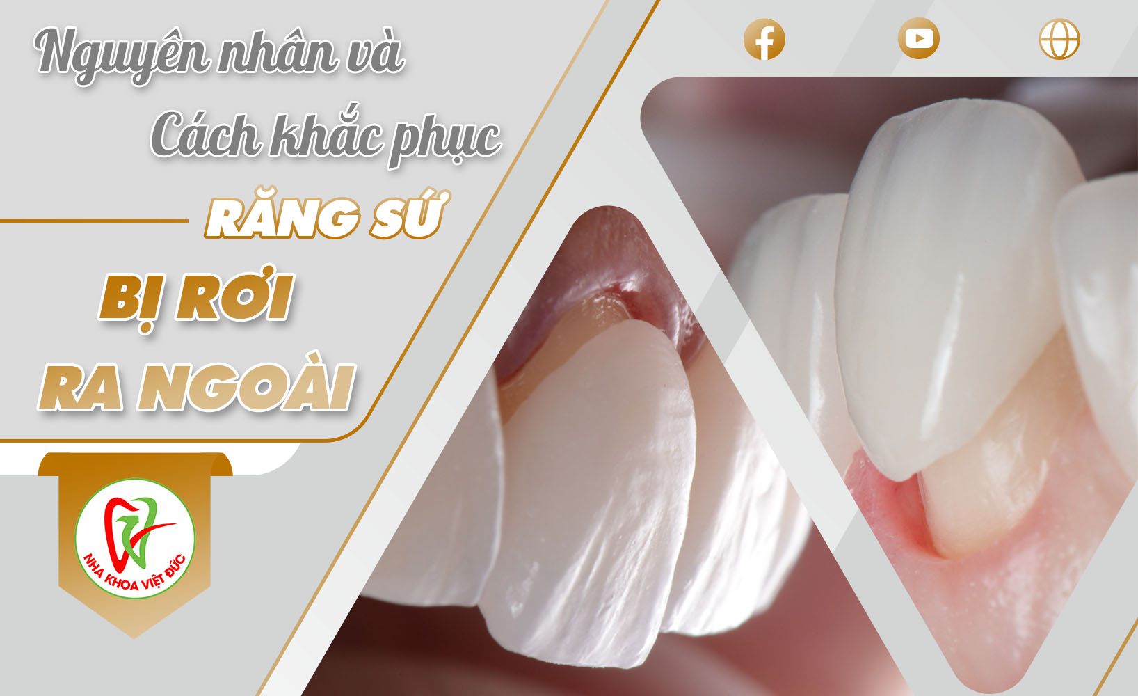 NGUYÊN NHÂN VÀ CÁCH KHẮC PHỤC RĂNG SỨ BỊ RƠI RA NGOÀI?