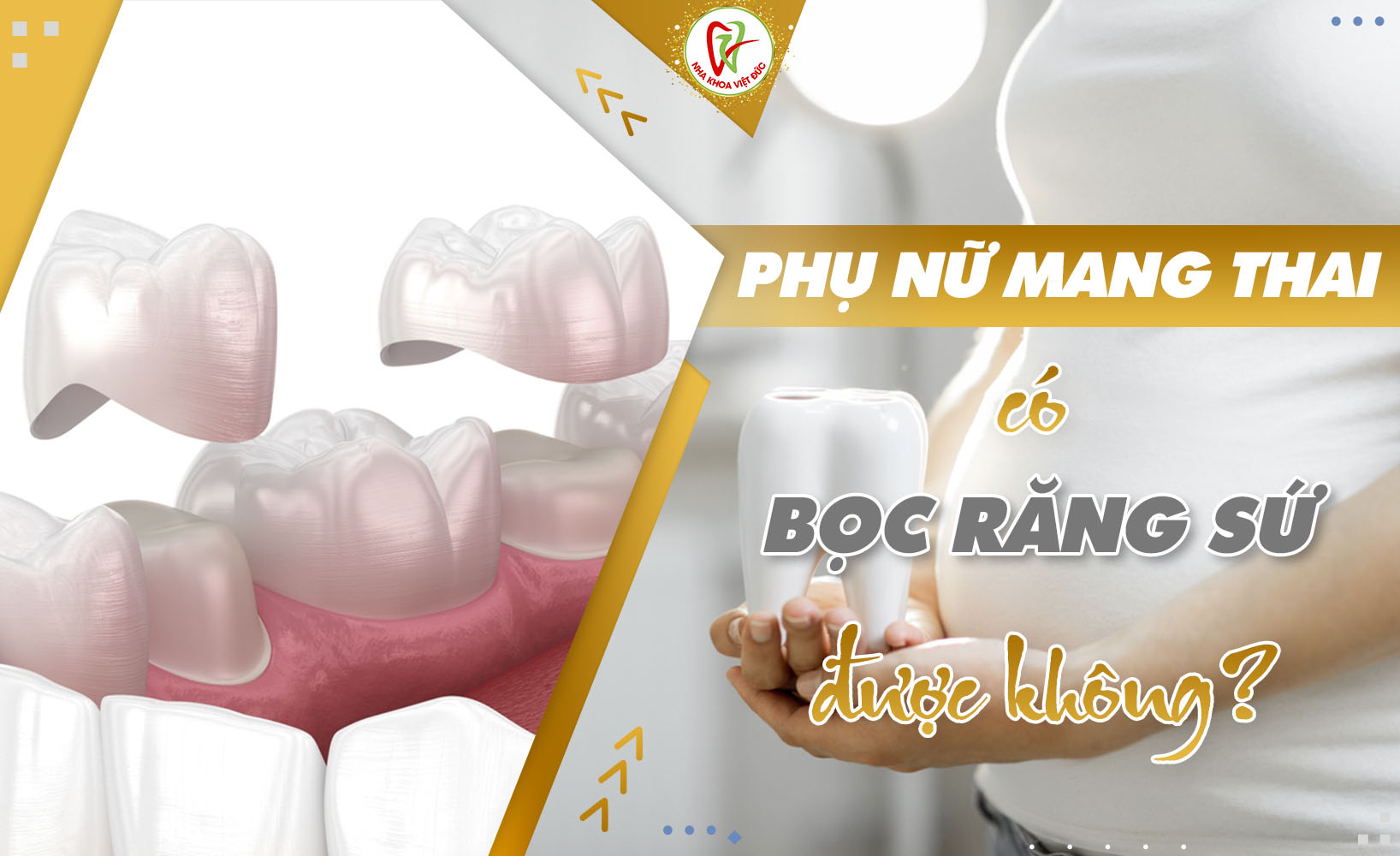 PHỤ NỮ MANG THAI CÓ BỌC RĂNG SỨ ĐƯỢC KHÔNG?