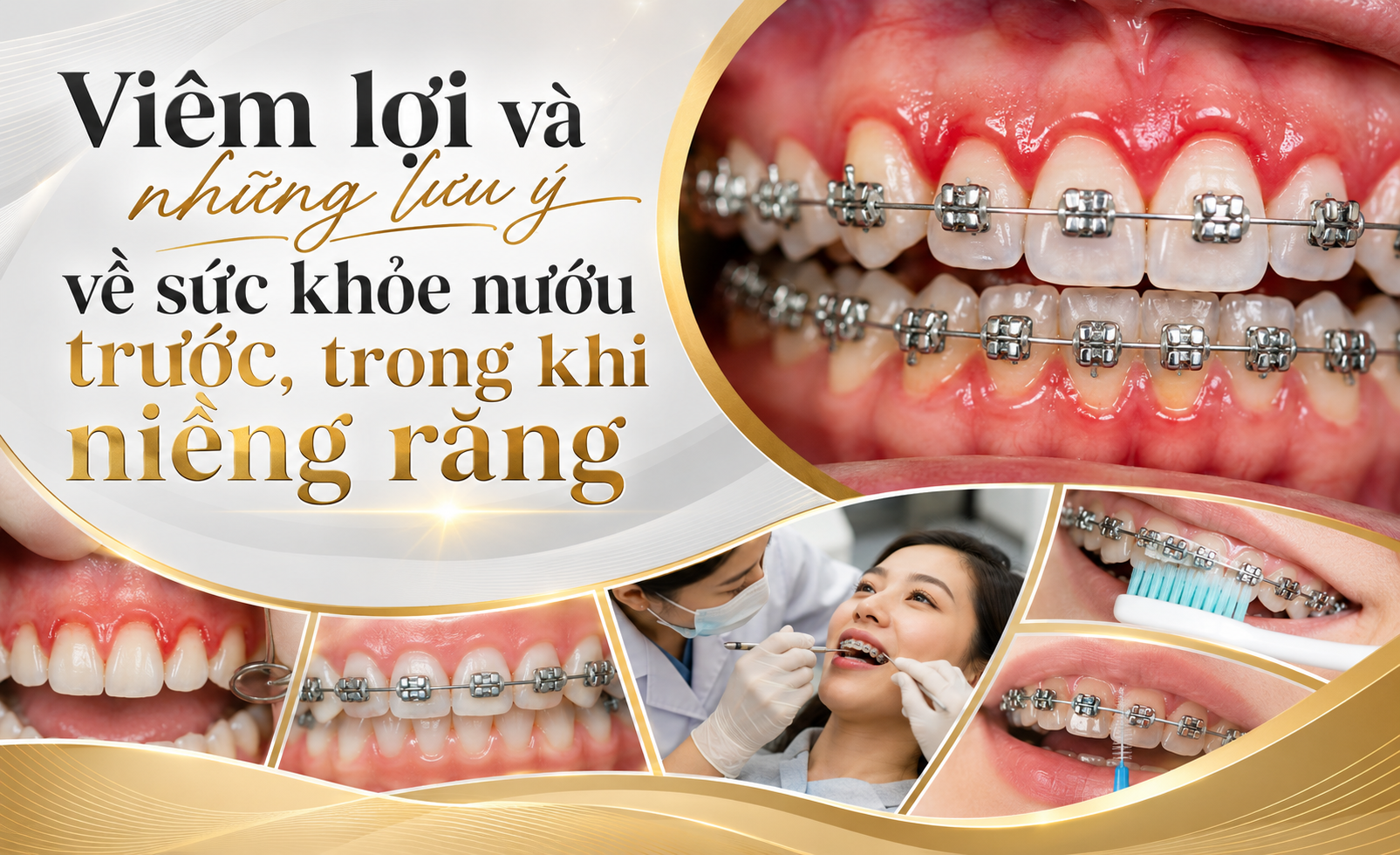 Nướu đang viêm có nên niềng răng không?